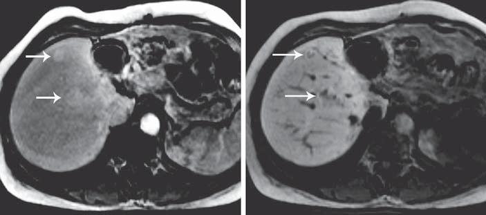 Fig. 6. MRI with heptobiliry contrst gent of typicl FNHs. On T 1 -weighted rteril phse imges, two smll lesions with strong homogeneous enhncement re visible (rrows) ( ).