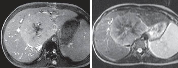 In the rteril phse, on T 1 -weighted imging, strong enhncement of the lesion is seen except for the stellte centrl re ( ).