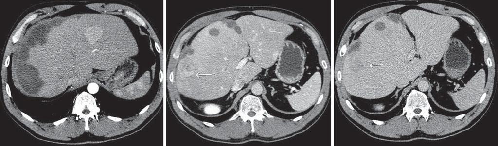 b c Fig. 9. CT scn of mle bodybuilder using steroids who presented with n cute bleeding. In the rteril phse, bleeding nd multiple enhncing lesions were seen (only one shown) ( ).