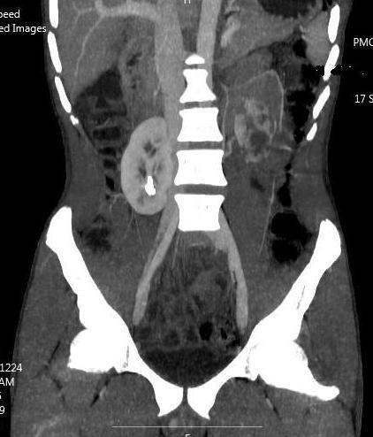 2cm with delayed excretion of contrast (Figure 1). The left kidney had a pelvi ureteral junction (PUJ) obstruction and marked rotational anomaly (Figure 2).