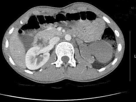 Figure 3: Coronal MIP reconstruction of contrastenhanced CT shows inferiorly located right inferior supernumerary kidney had multiple calculi at pelvicalyceal system (arrow).