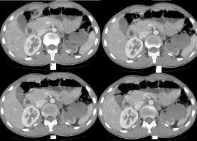 Figure 4(A-D): Axial contrast-enhanced CT reveals the artery of the right cranial kidney originating from the abdominal aorta (small arrow) and marked rotational anomaly of left hydronephrotic kidney