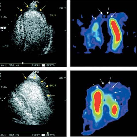 Figure 7 Representative myoardial ontrast ehoardiography (MCE) and SPECT images obtained in a patient with anterior myoardial infartion, showing a larger perfusion defet by SPECT than MCE: (top left)