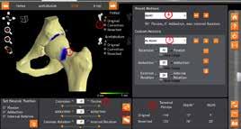 3D Static Assessment Femoral Offset Analysis Acetabular Coverage Analysis 4D Assessment Tools