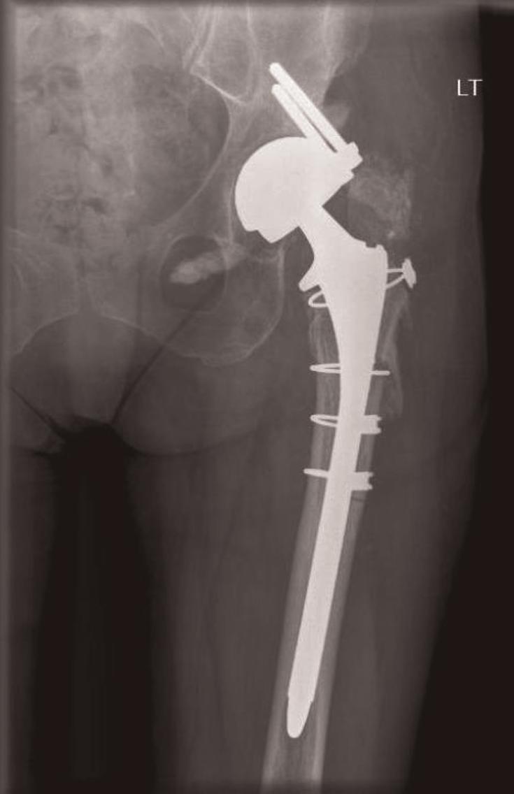 screws as a whole [1]. It has been utilised effectively in dysplastic hips with bone defects. But does it provide similar effect when used in revision arthroplasty was the reason behind this report.