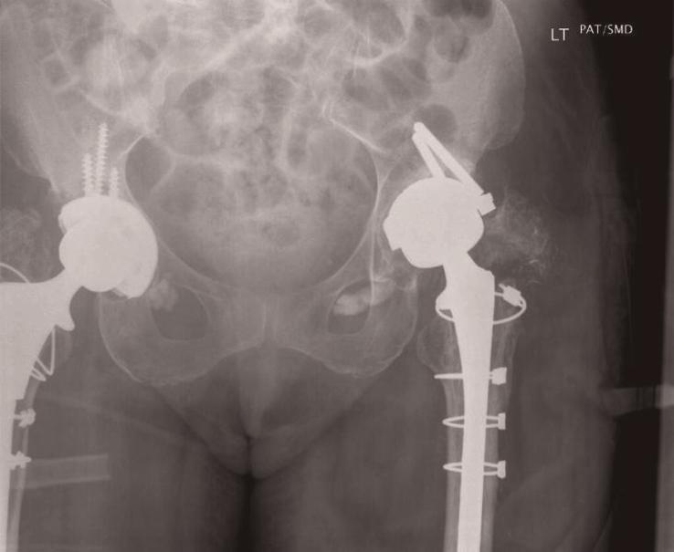 Cases Journal 2009, 2:8716 Figure 3. Radiograph at 8th month postoperative period showing broken acetabular screws.