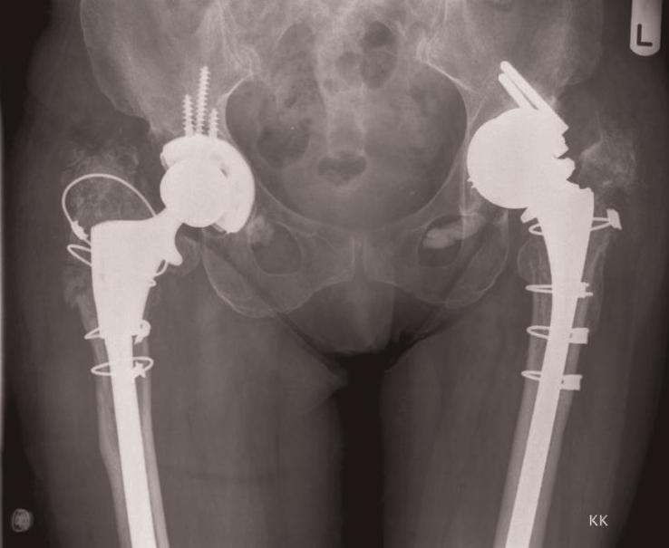 If we considered patients with dysplastic hips to be in group A and patients with aseptic failure of acetabular cups to be in group B, a comparison of these two groups would identify the suitability