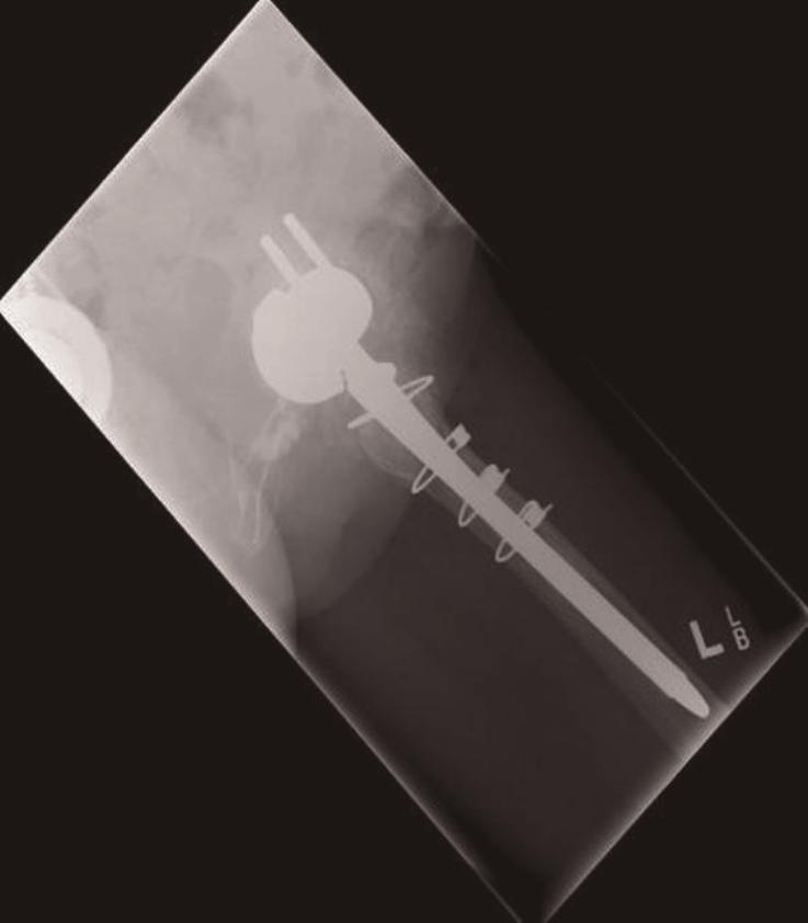 Radiograph at 12th month postoperative period showing a posterior inferior migration of acetabular cup in Lateral view. who are more often in the elderly population.