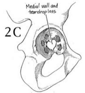 Type 2 C- Intact Rim Localized destruction of medial wall Migration of the acetabular