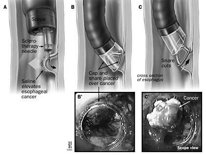 Endoscopic Mucosal Resection (EMR) for HGD and superficial Ca EMR - Cap Can be diagnostic and therapeutic Often utilized in combination with ablative techniques Essential for removal of nodules when