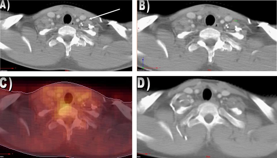 (C) FDG-PET image of the left cervical area demonstrating no suspicious PET avidity. (D) Left cervical area after chemotherapy with the disappearance of the lymph node.