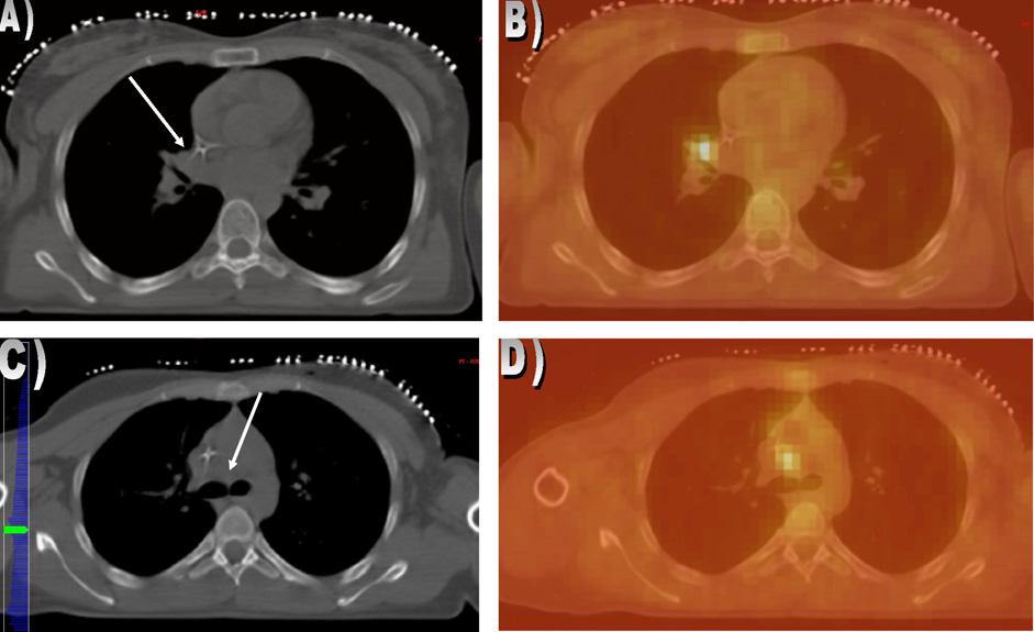 T. Girinsky et al. / Radiotherapy and Oncology 88 (2008) 202 210 207 Fig. 8. (A) Apparently normal hilar areas before chemotherapy. (B) FDG-PET showing a small right hilar lymph node.