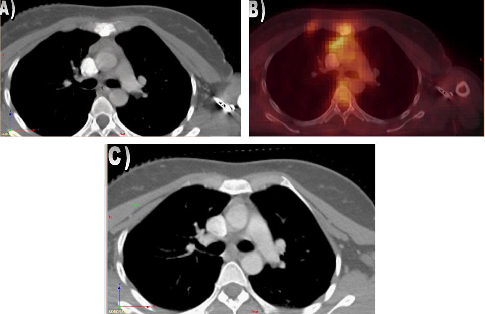 208 Involved lymph nodes in Hodgkin lymphoma Fig. 10. (A and B) Asymmetry in the internal mammary lymph node chains on CT and FDG-PET. (C) Disappearance of asymmetry after chemotherapy. Fig. 11.