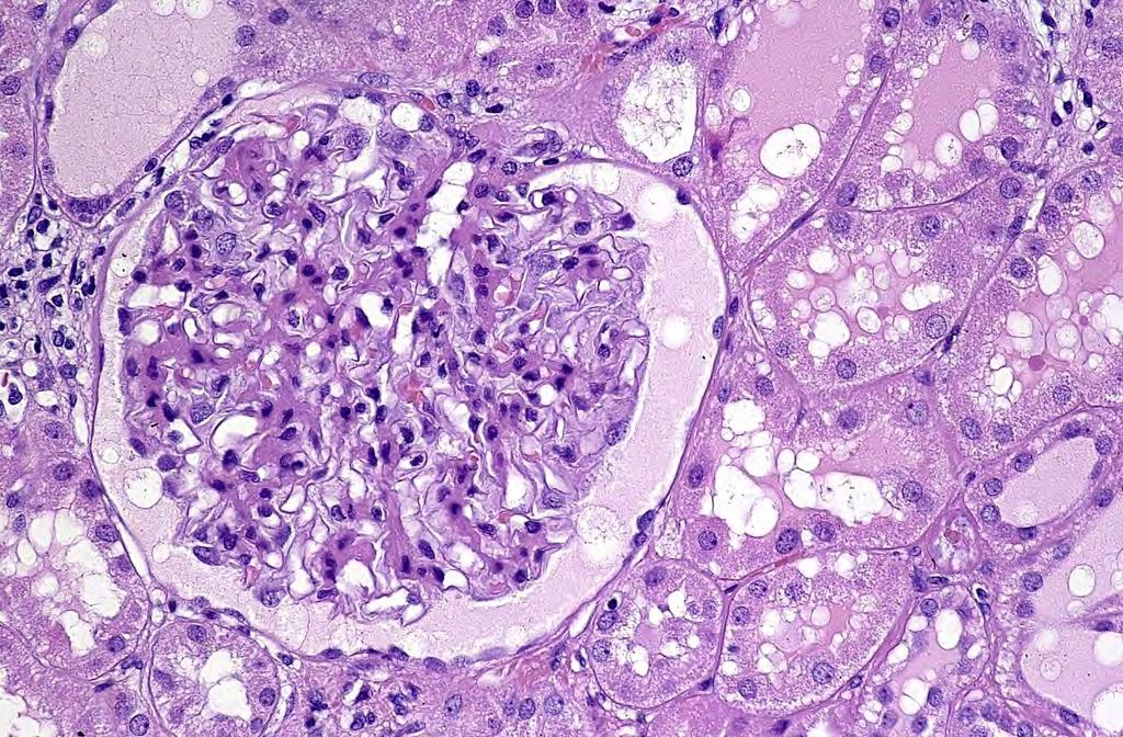 Normal glomerulus and tubules.