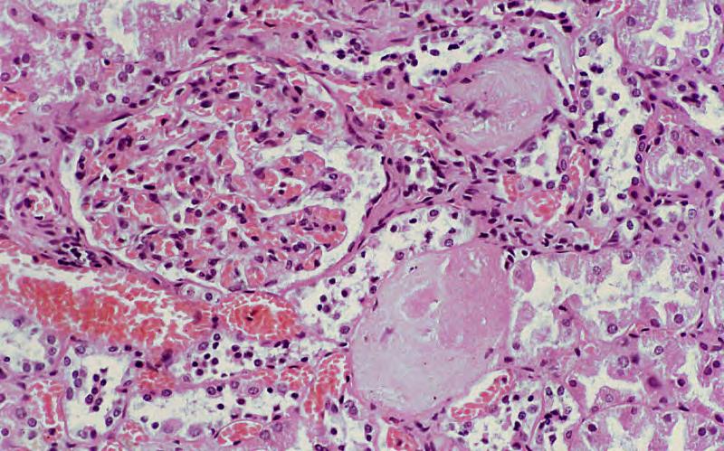 Obsolescent or sclerosed glomeruli (yellow arrows). Chronically injured glomeruli from any cause (e.g. chronic ischaemia, immunological damage) become fibrosed and frequently atrophied.