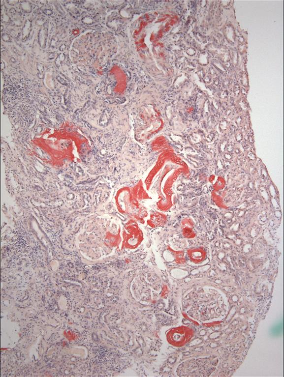 Case Reports in Nephrology 3 (a) (b) Figure 2: Congo red staining with red affinity primarily in the wall of the vessels and in the interstitium (a).