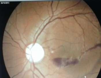 Four (28.57 %) had proliferative diabetic retinopathy and three patients (21.42 %) had macular subhyaloid haemorrhage due to Valsalva maneuver & idiopathic.2(14.