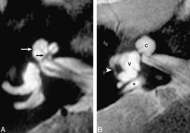 B, Axial T2-weighted FSE MR image in another patient shows moderate modiolar deficiency with near absence of the normal soft-tissue core at the central cochlear axis (arrow).