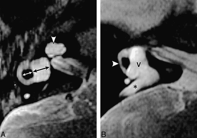 B, Axial image 2 mm below A also shows asymmetric enlargement of the anterior chamber (arrow). The posterior chamber (arrowhead) comprises the scala tympani, which is normal in size.