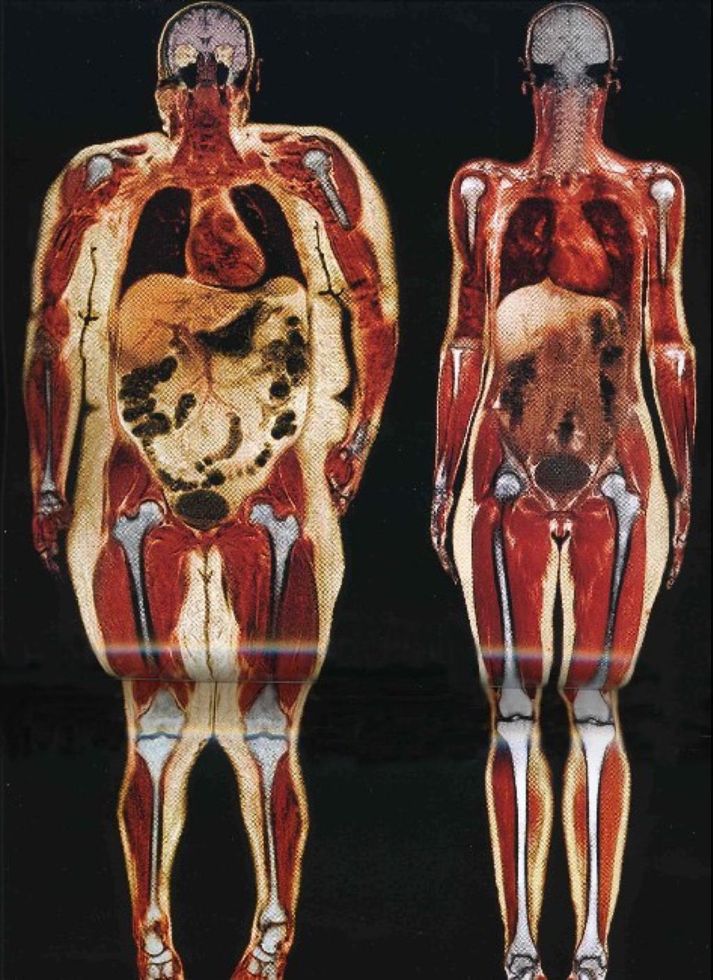 The obese woman on the left has fat around her organs (shown by the yellow areas) and an enlarged heart which can have dire consequences on her health Notice anything?