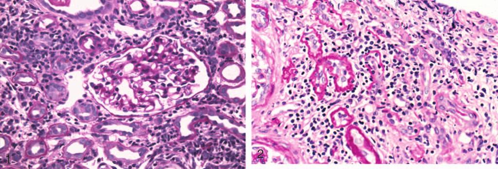 Patient Presentation and Characteristics of Plasma Cell Dyscrasia (PCD) at the Time of Renal Biopsy* Age, y/sex 55/F 88/F 74/M 72/M 66/F 68/F 80/F 68/F Creatinine, mg/dl 9.0 5.7 3.8 3.1 6.