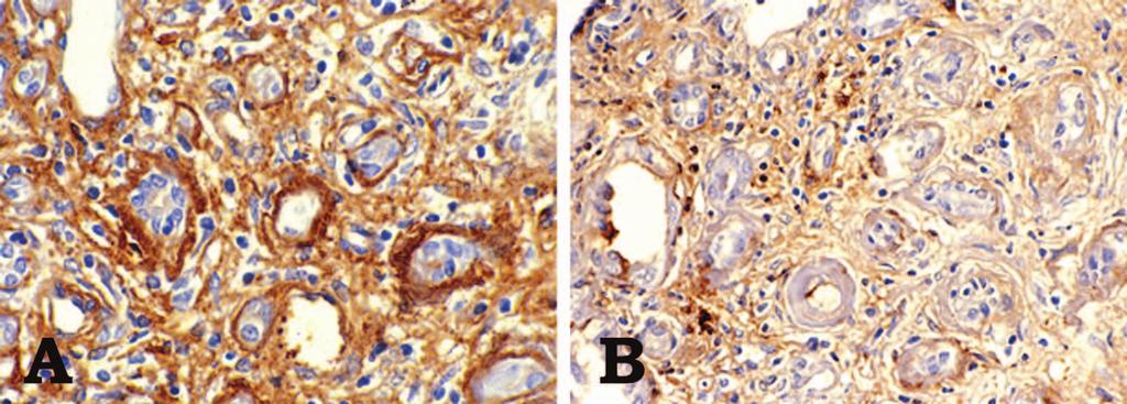 Figure 3. Immunohistochemistry. A, light-chain staining along the tubular basement membrane is clearly seen.
