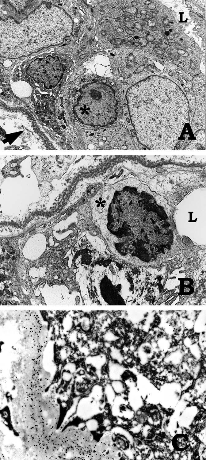 Figure 4. Low-power (A) and high-power (B) transmission electron microscopy views reveal tubulitis with infiltration of lymphocytes into tubules.