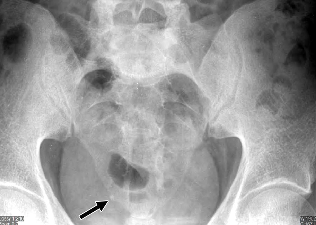 The traveling small stone obstructed the orifice of ureter
