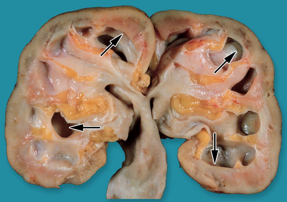 Hydronephrosis: dilated calyces,