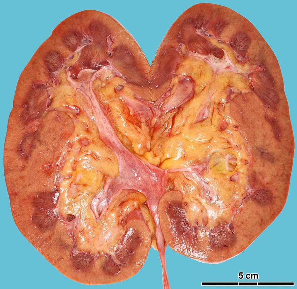 Shock kidney enlarged, swollen kidney (~