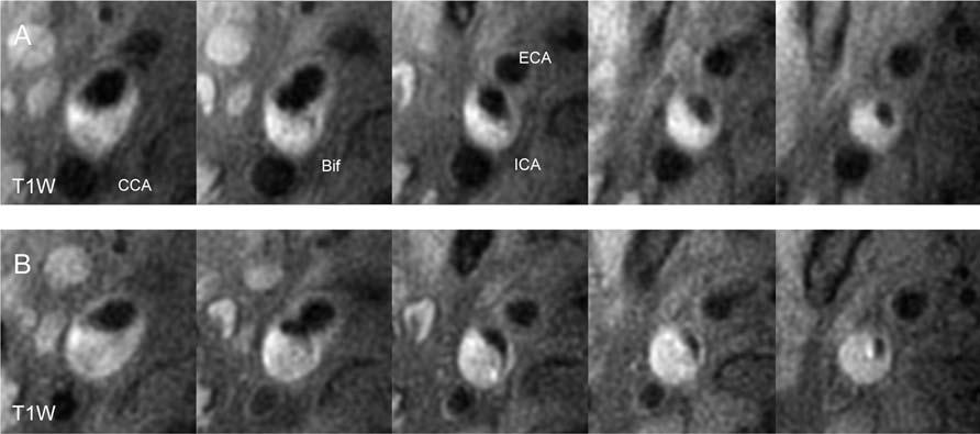 Figure 2 Representative T1-weighted images of the progression of atherosclerosis with intra-plaque hemorrhage in the right carotid artery.