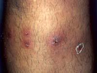 SYMPTOMS OF STAPH INFECTIONS The symptoms of a staph infection depends on where the infection is.