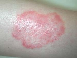 Cellulitis a flat skin infection which can make the