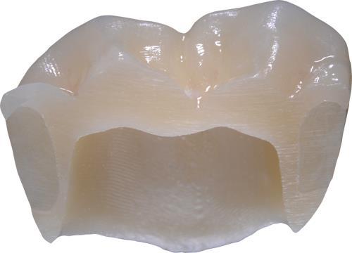 Caries Inhibiting Effectiveness of the Origin SmartCrown An in-vitro Comparative Study B&D Dental Corporation Key Words Resin modified glass ionomer; Interproximal caries; Adjacent surfaces; Fluoride