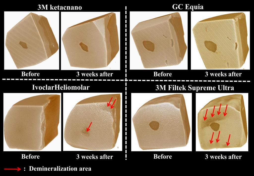The enamel surface adjacent to the SmartCrowns containing RMGI filling materials (Ketac nano, Equia) did not show any demineralization, whereas the fluoride releasing composite (Helliomolar) and