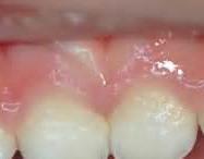 Stages of ECC Plaque: Dental