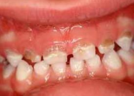 Stages of ECC Dentine caries: ECC has extended through the entire layer of