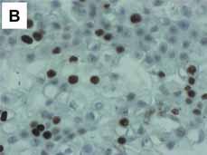 (B) In the high PI index tumor, the Ki- stained positive tumor cells were observed frequently in the nuclei of intermediate and epidermoid cells.