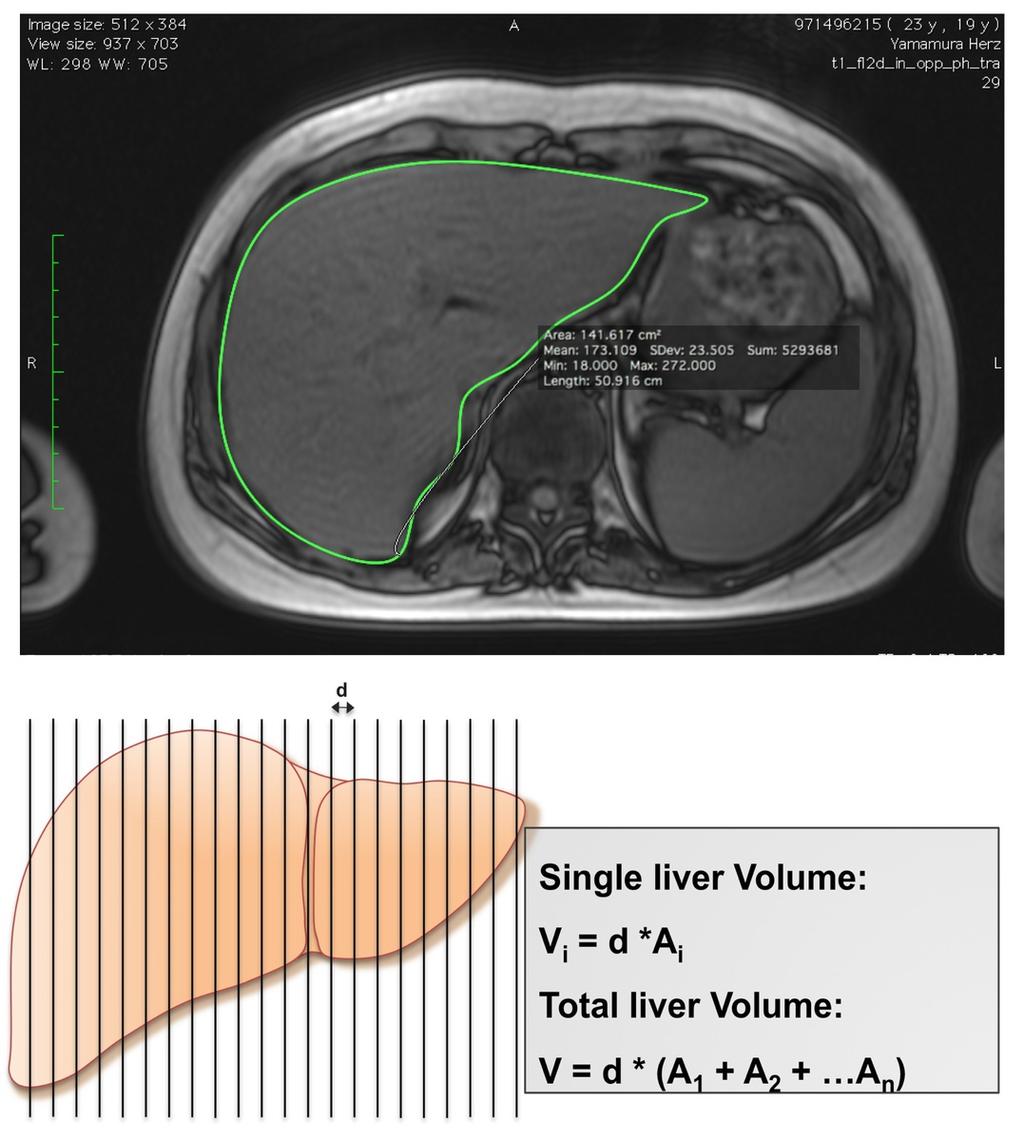 Fig. 1: Volumetry by MRI (OsiriX software version v.5.8.
