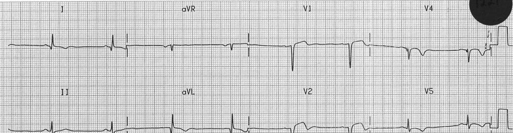 ST ELEVATION in BER Greatest in precordial leads (V2-V5) Usually < 2mm Minimal in limb leads Usually < 0.