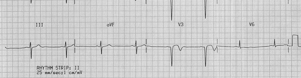 notched; best seen in V4-5 Often notching of downstroke of QRS R waves: tall in L precordial leads; R shift of transition zone IS IT ISCHAMEIA?