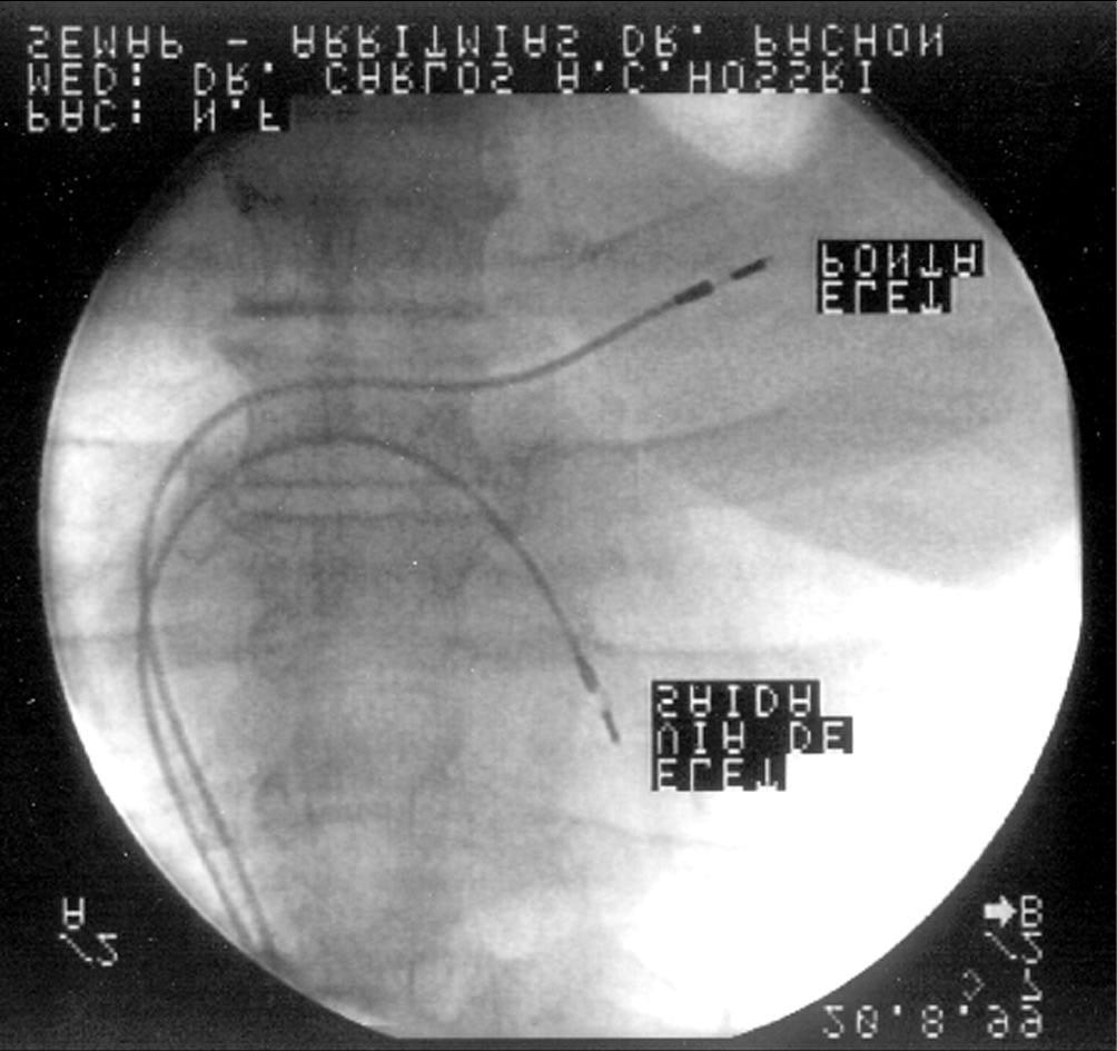 Four patients had definitive pacemakers with elective indication to change the generator due to battery depletion.