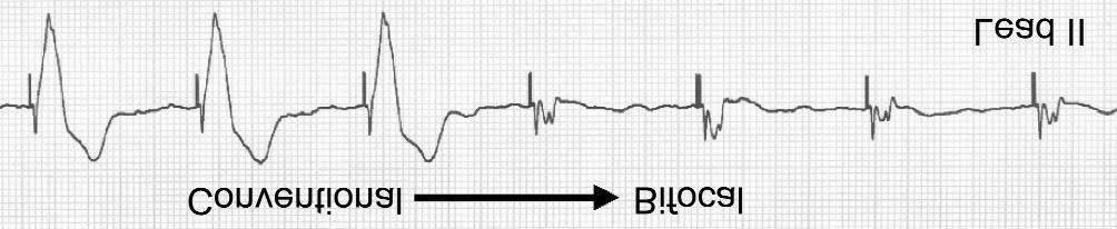 In those 5 sinus rhythm patients, only two ventricular pacing modes were compared: The DDD mode with bifocal ventricular pacing, with the pacemaker programmed to classic DDD mode with ventricular