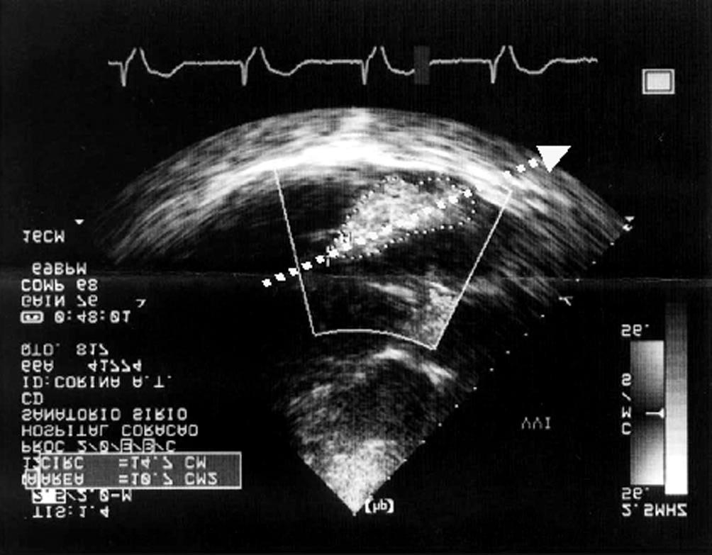 236 June 2000 Figure 4. Echocardiographic study switching from conventional to bifocal pacing.