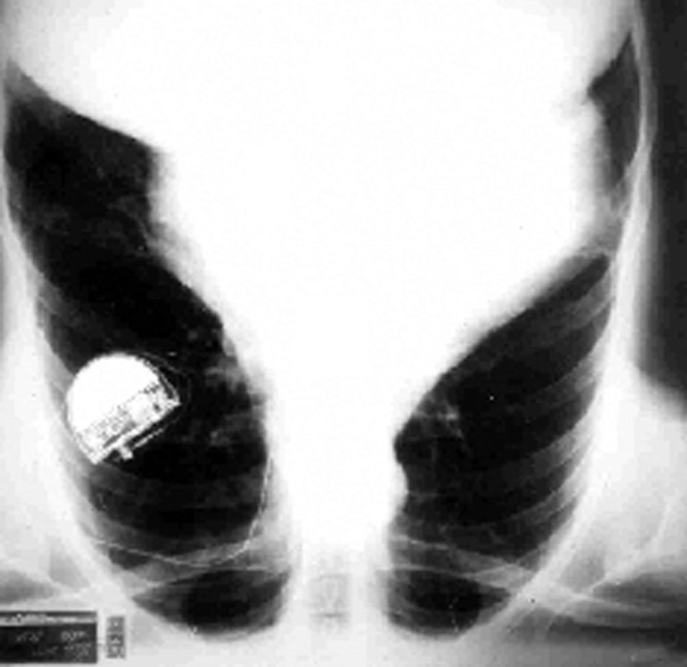 238 June 2000 Figure 8. X-Ray comparison in Chagas' disease patient with long time conventional pacemaker (left).