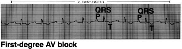 AV Heart Blocks 1 st degree A condition of a rhythm, not a true rhythm Need to always state underlying rhythm 2 nd degree Type I - Wenckebach Type II Classic dangerous to the patient Can be variable