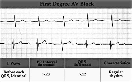 2:1) 3 rd degree (Complete) dangerous to the patient 215 Atrioventricular (AV) Blocks Delay or interruption in impulse conduction in AV node, bundle of His, or His/Purkinje system Classified