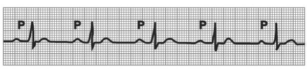 Clinical significance dependent on: ü Degree or severity of the block ü Rate of the escape pacemaker site Ventricular pacemaker site will be a slower heart rate than a junctional site ü Patient s