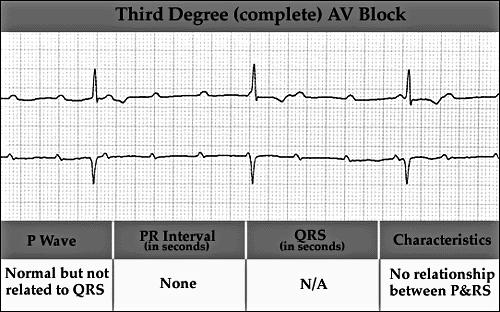 3 rd Degree (Complete) Complete AV block 227 228 Arrhythmia: conduction failure at AV node
