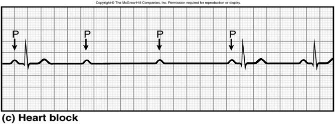 APs can pass to ventricles Causes P waves with no QRS In third-degree or complete AV node